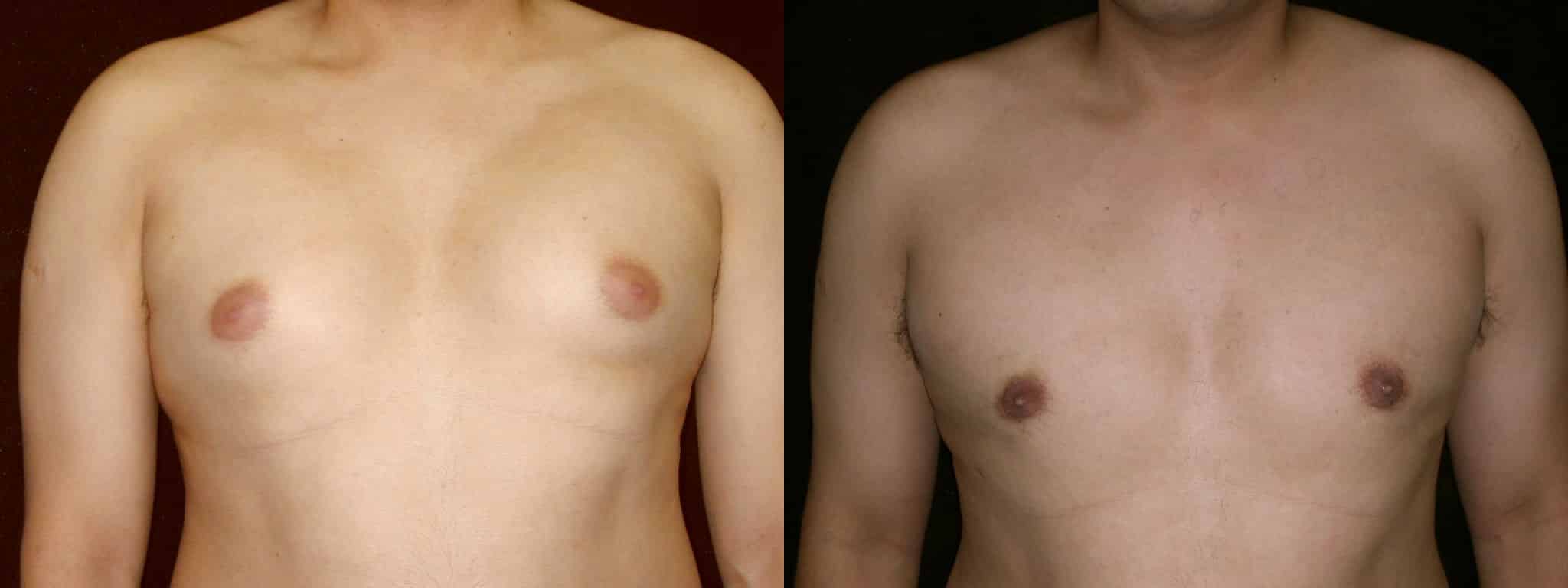 Gynecomastia Patient 18 Before & After