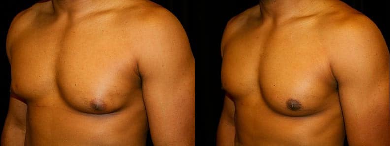 Gynecomastia Patient 6 Before & After Details