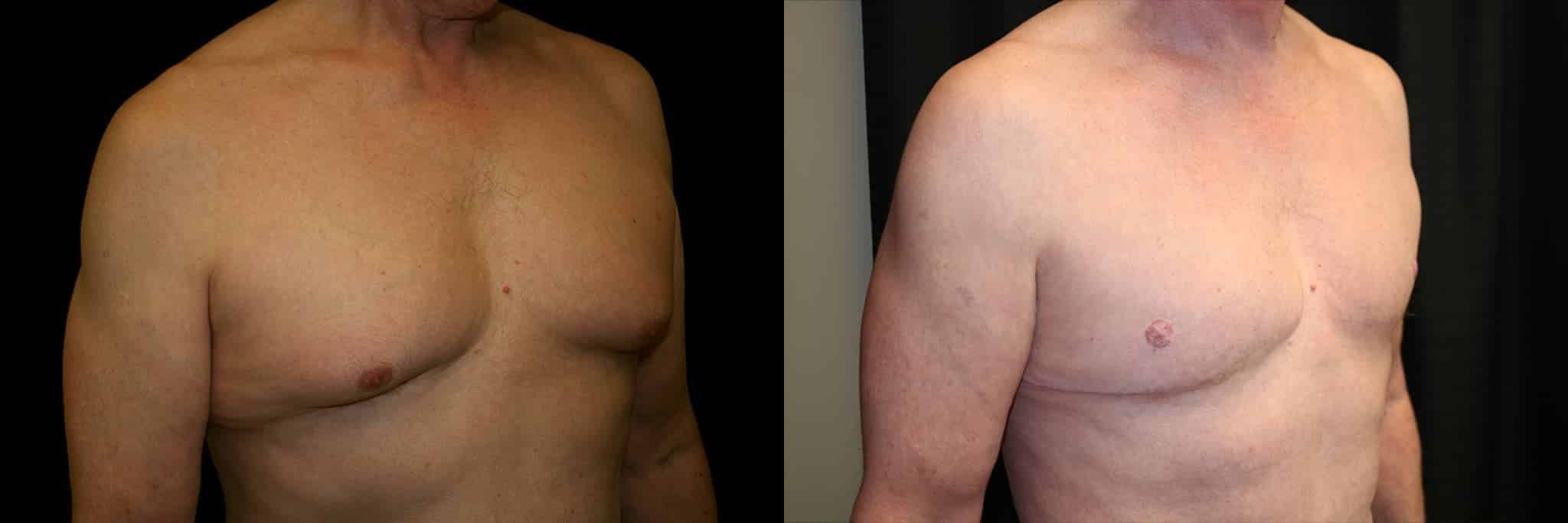 Gynecomastia Patient 18 Before & After Details