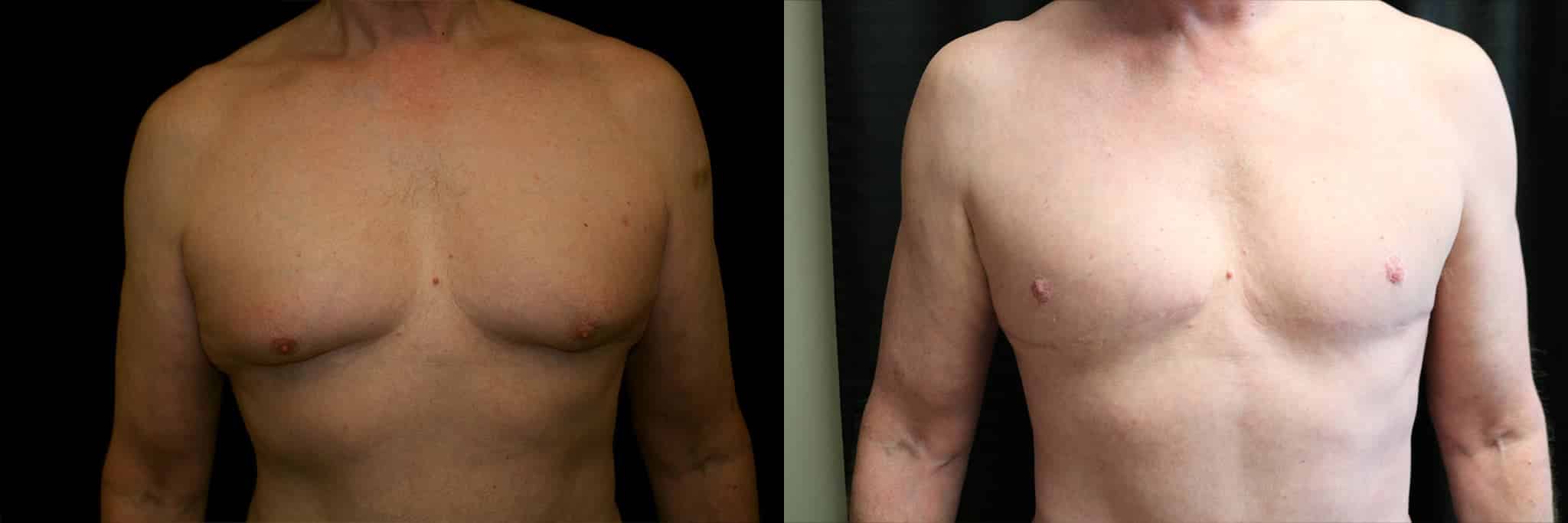 Gynecomastia Patient 18 Before & After