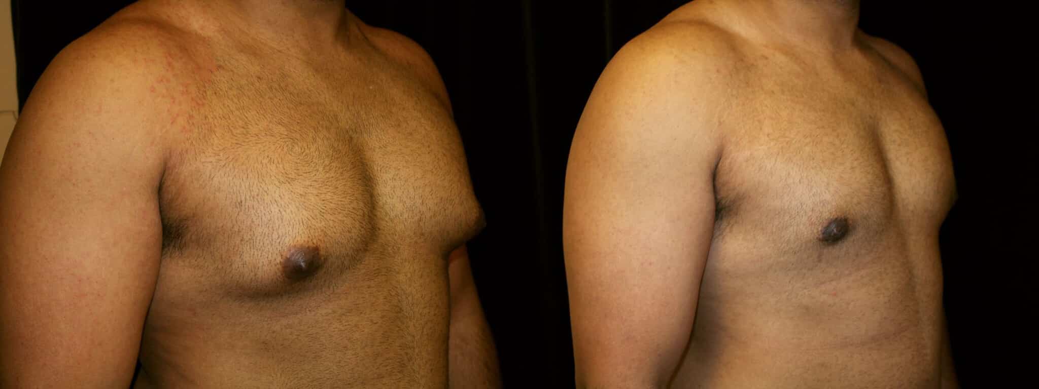 Gynecomastia Patient 10 Before & After Details