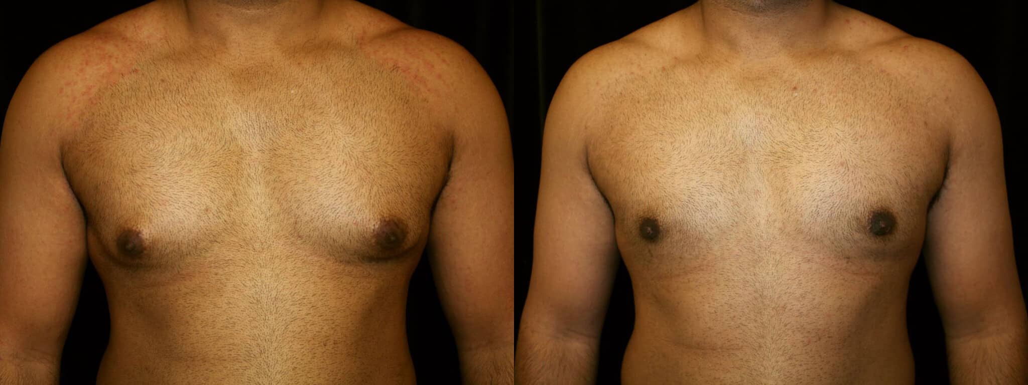 Gynecomastia Patient 10 Before & After