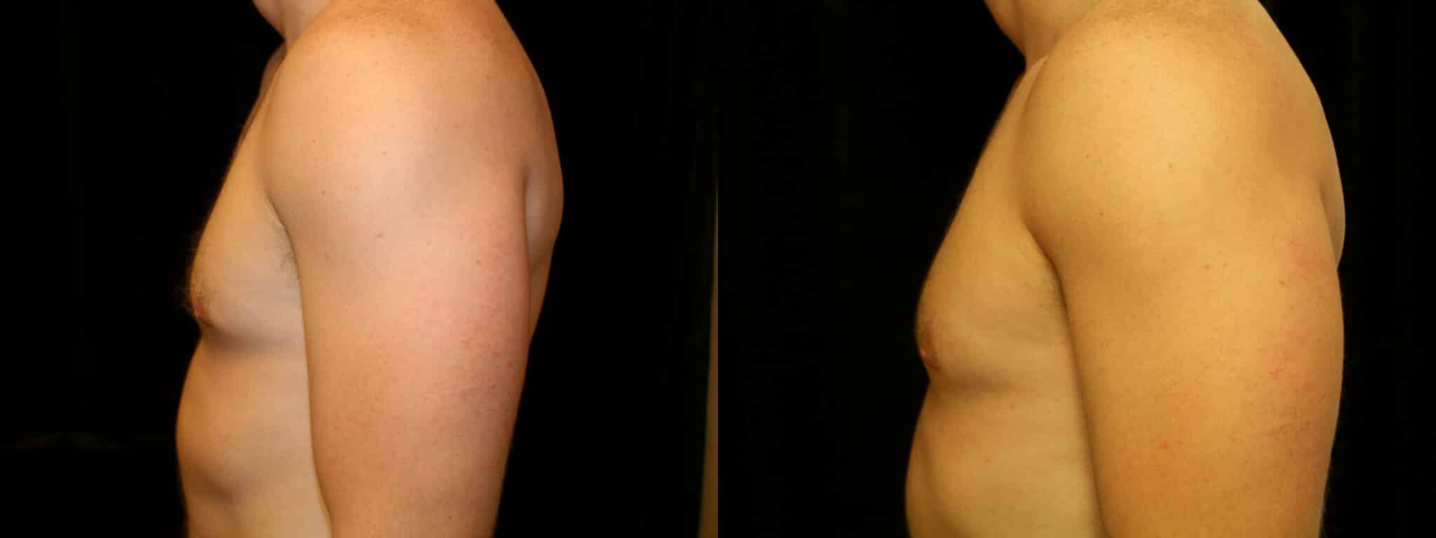 Gynecomastia Patient 9 Before & After Details