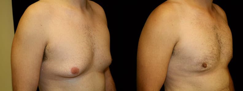 Gynecomastia Patient 11 Before & After Details