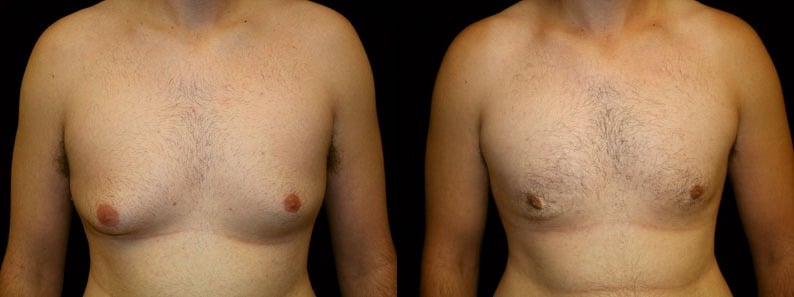 Gynecomastia Patient 11 Before & After