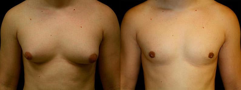 Gynecomastia Patient 5 Before & After