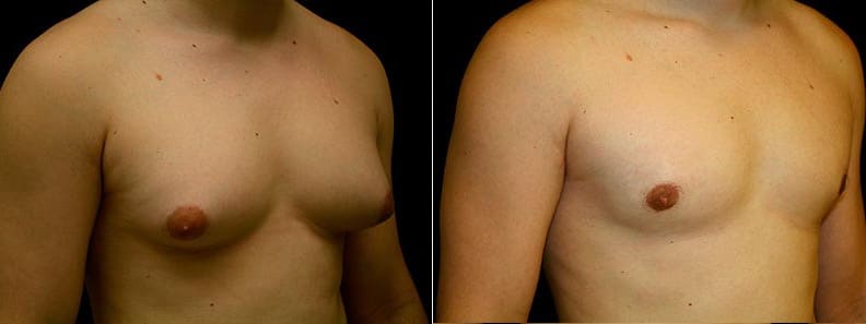 Gynecomastia Patient 5 Before & After Details