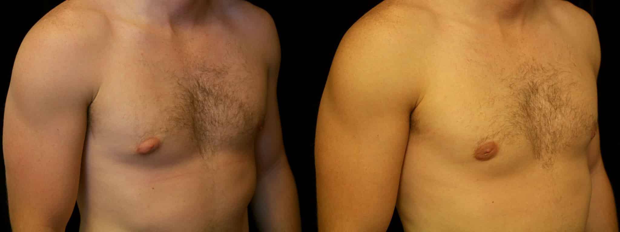 Gynecomastia Patient 9 Before & After Details