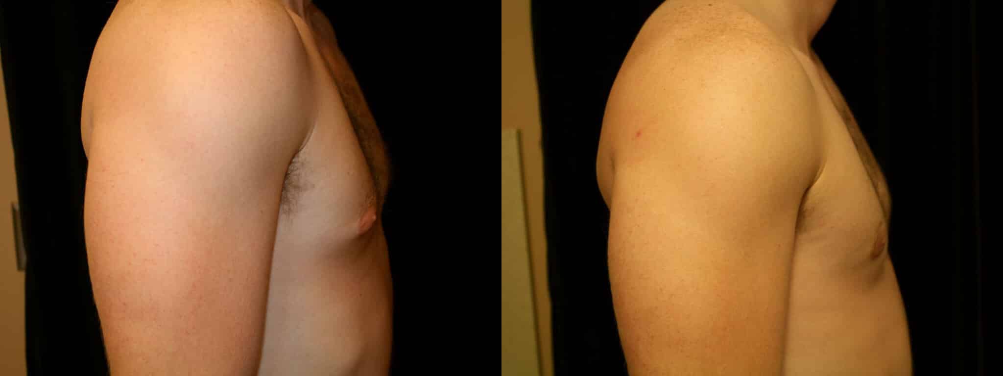 Gynecomastia Patient 9 Before & After Details