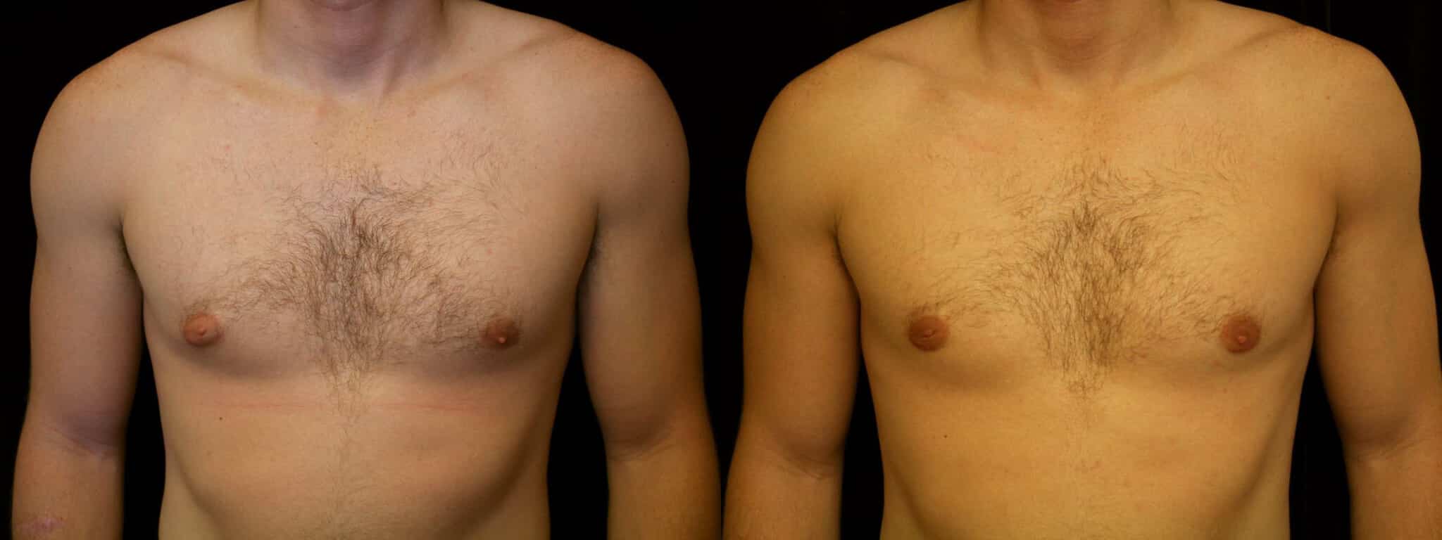 Gynecomastia Patient 9 Before & After