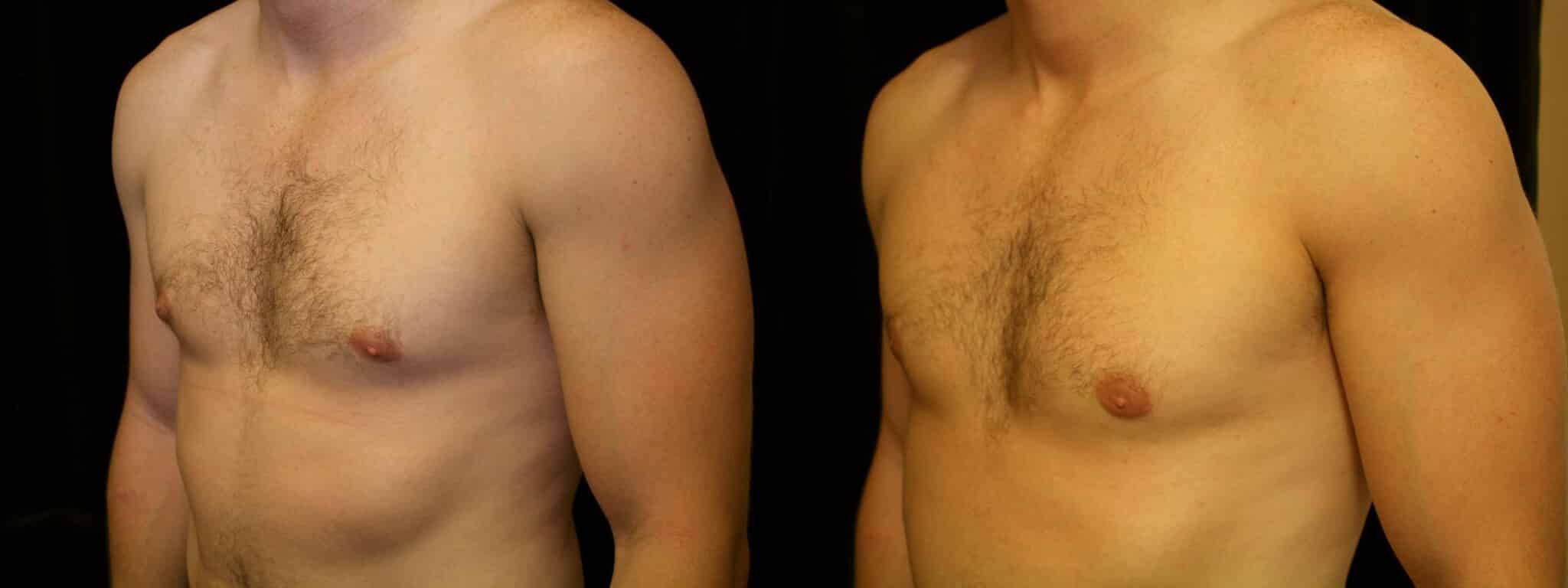 Gynecomastia Patient 9 Before & After Details