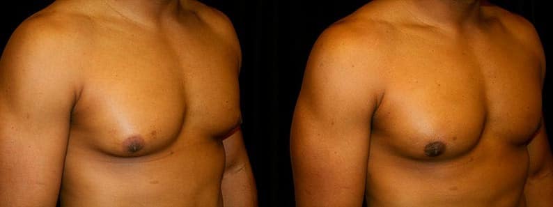 Gynecomastia Patient 6 Before & After Details