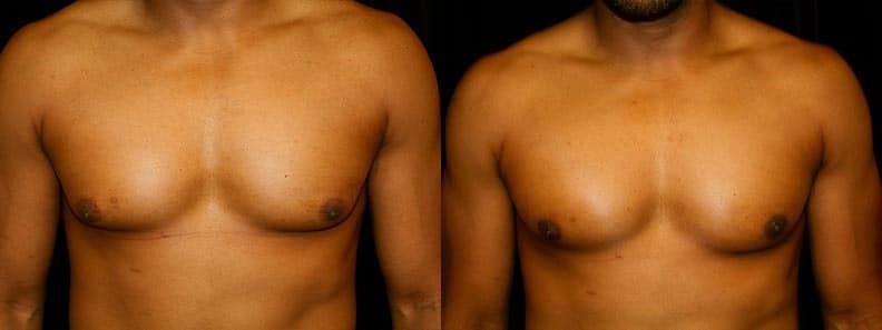 Gynecomastia Patient 6 Before & After