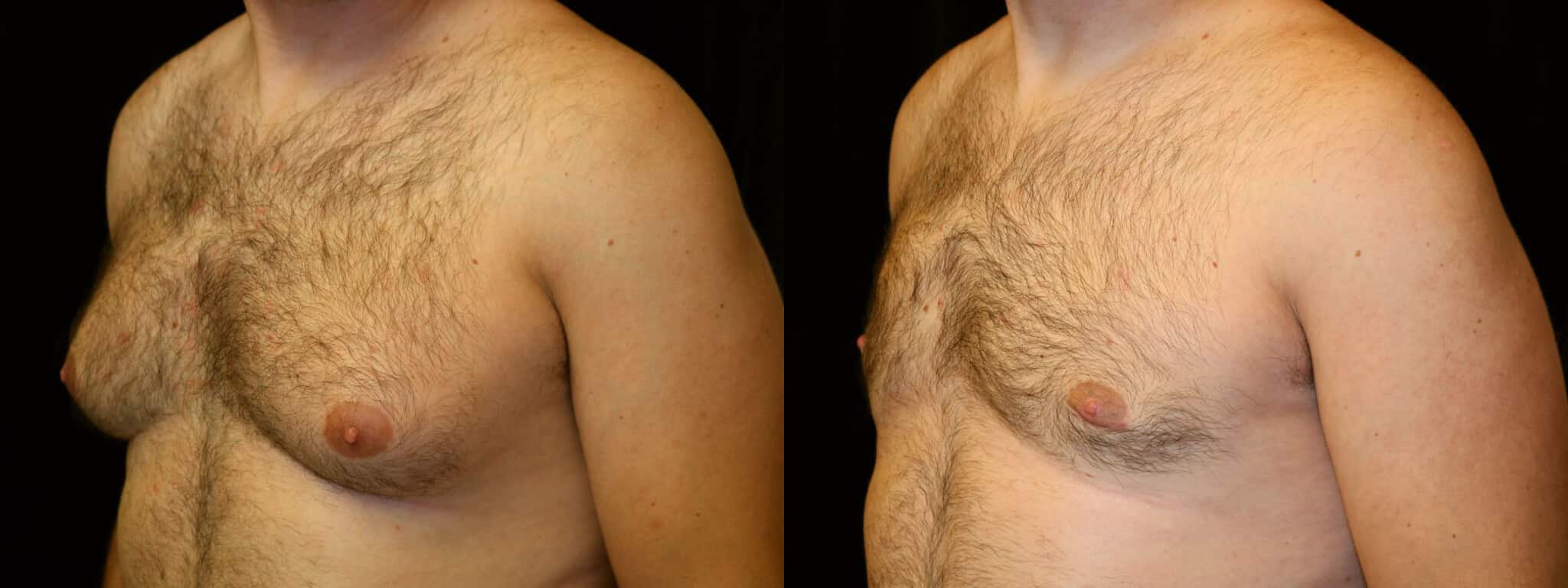 Gynecomastia Patient 1 Before & After Details