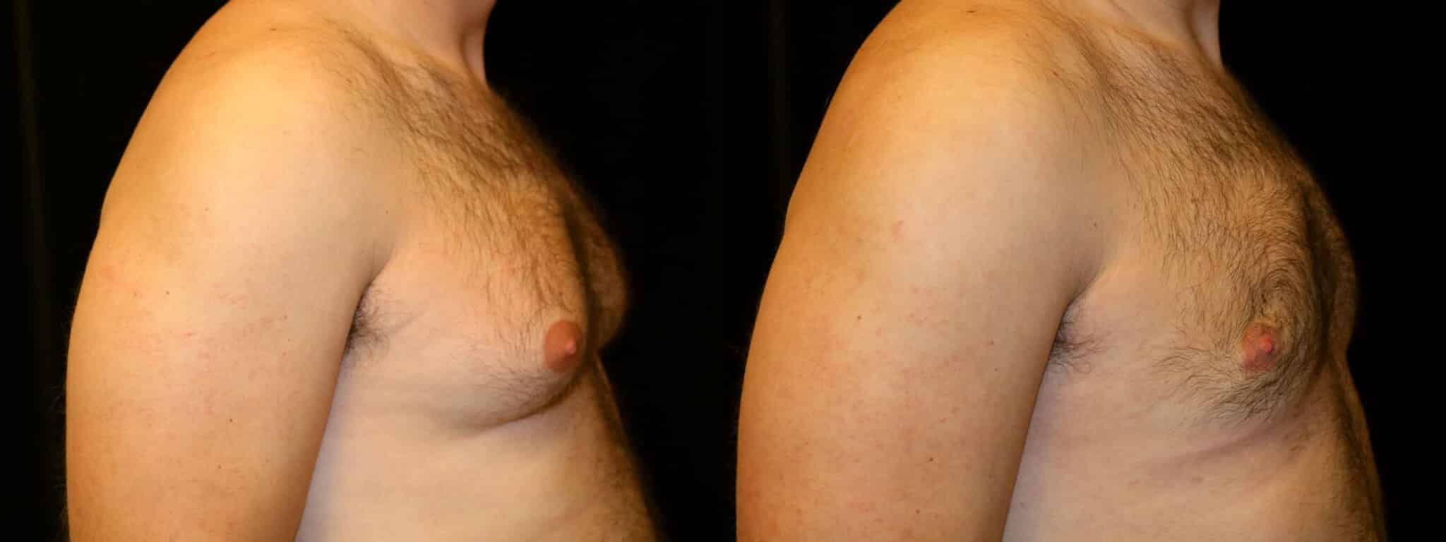 Gynecomastia Patient 1 Before & After Details