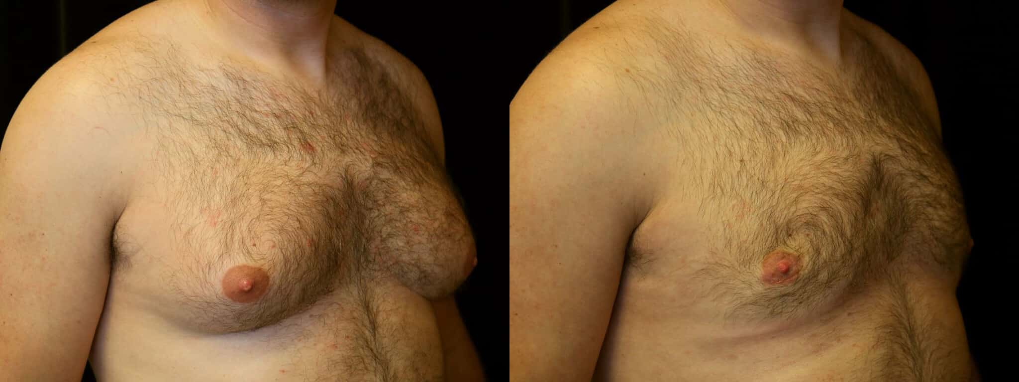 Gynecomastia Patient 1 Before & After Details