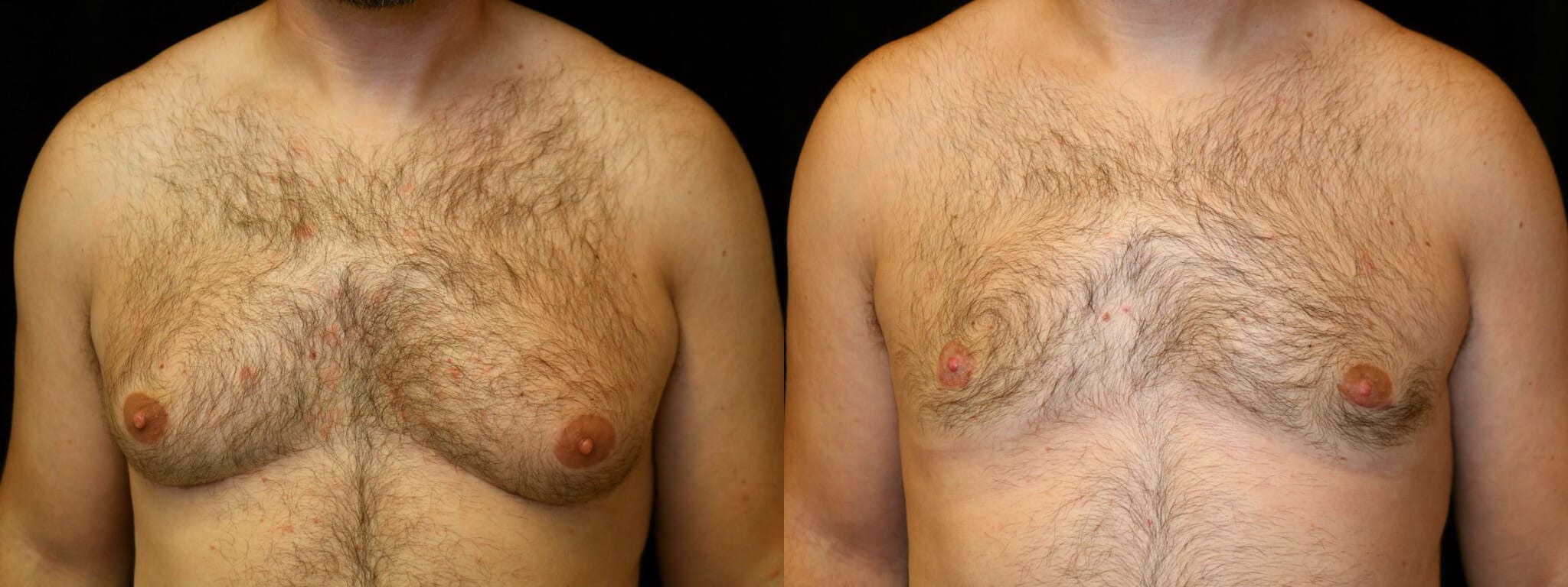 Gynecomastia Patient 1 Before & After