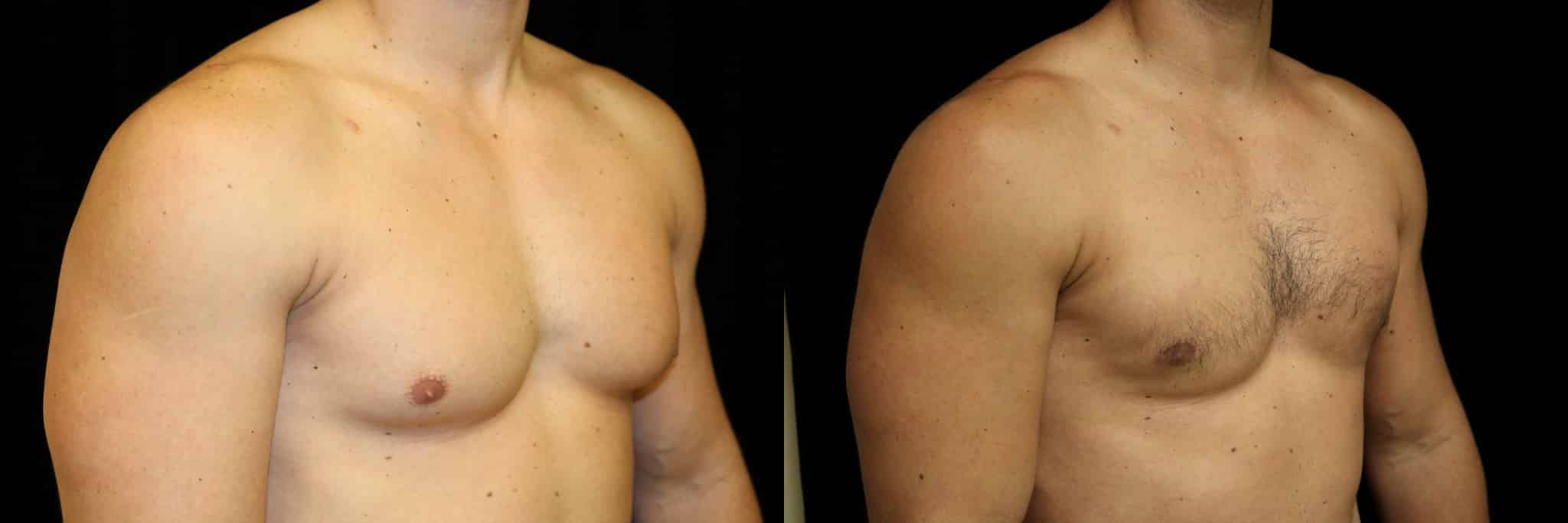 Gynecomastia Patient 19 Before & After Details