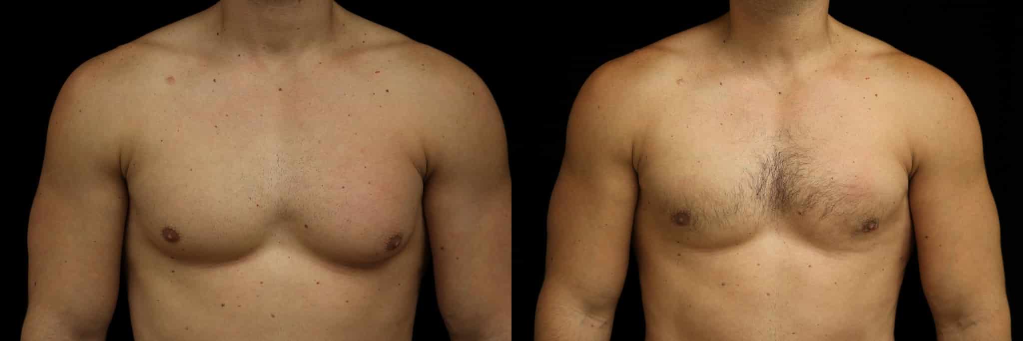 Gynecomastia Patient 19 Before & After