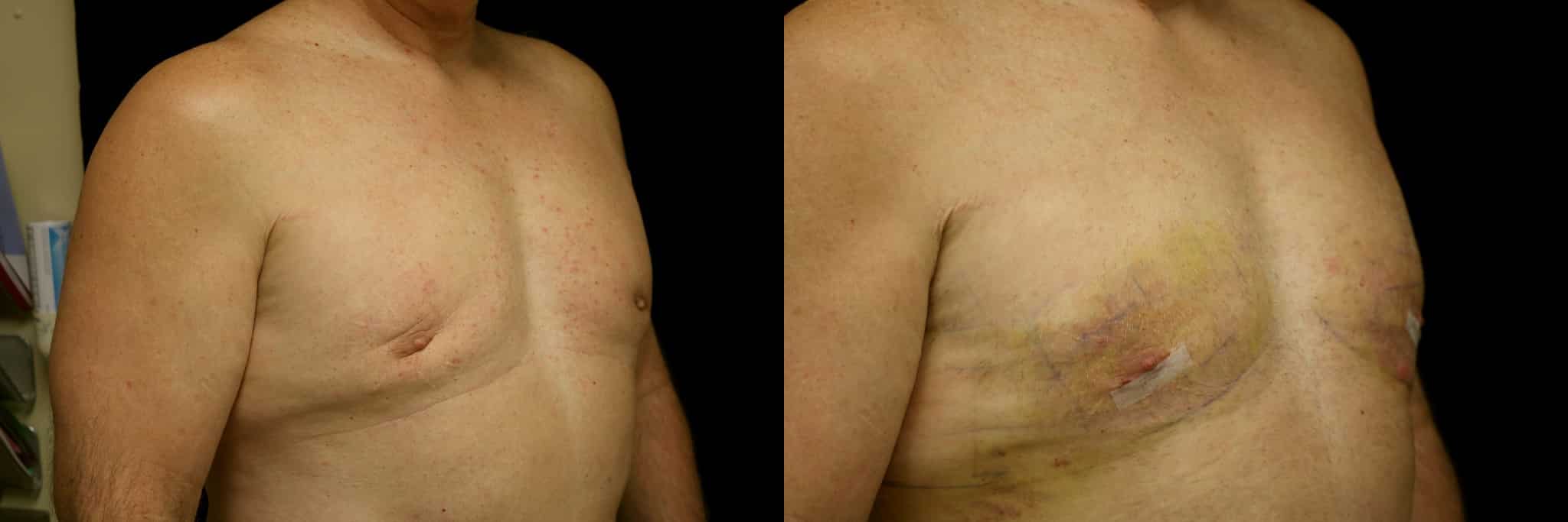 Gynecomastia Patient 2 Before & After Details