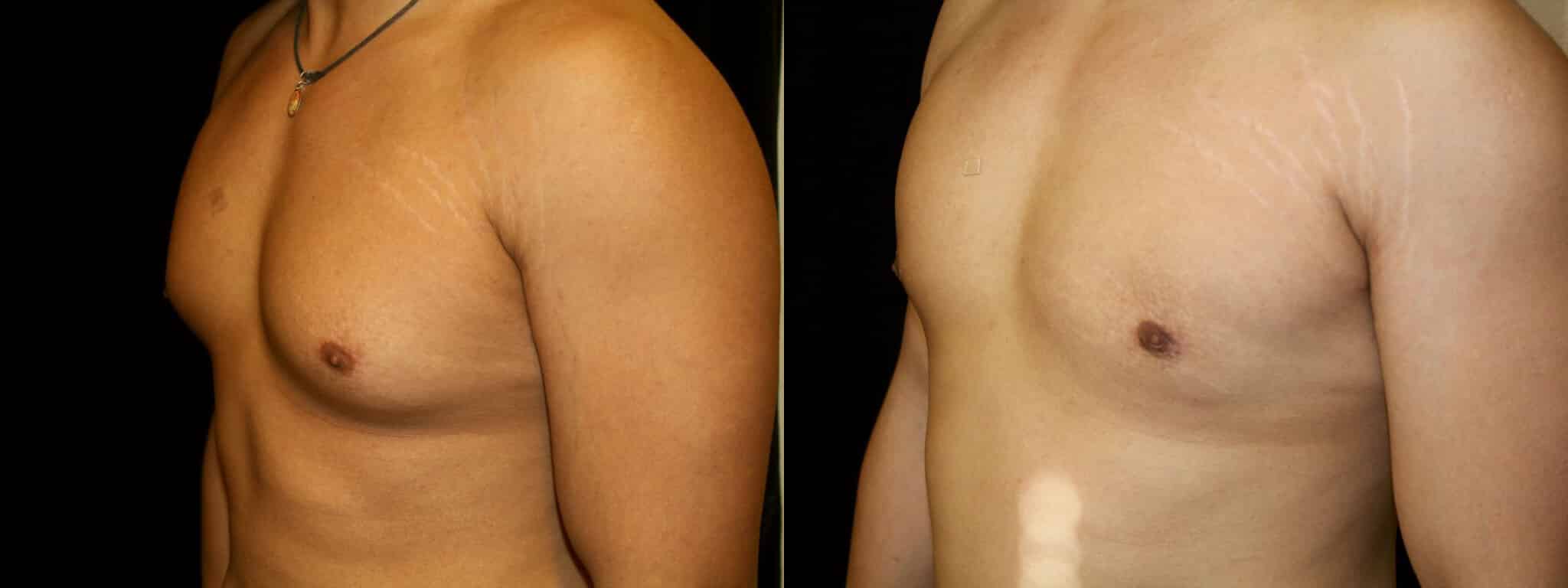 Gynecomastia Patient 14 Before & After Details