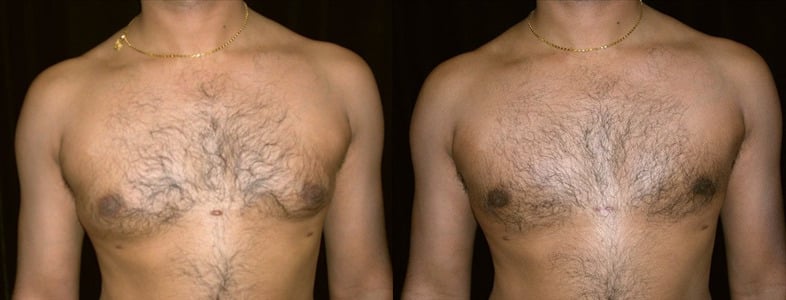 Gynecomastia Patient 20 Before & After