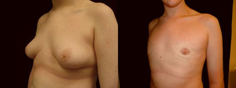 Gynecomastia Patient 16 Before & After Details