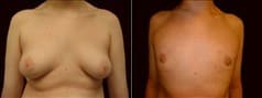 Gynecomastia Patient 16 Before & After