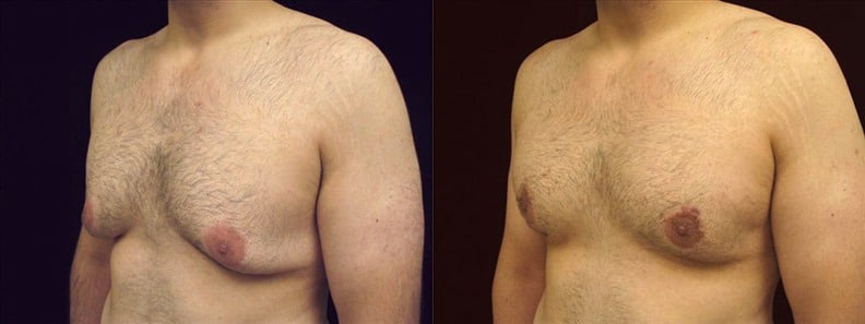 Gynecomastia Patient 20 Before & After