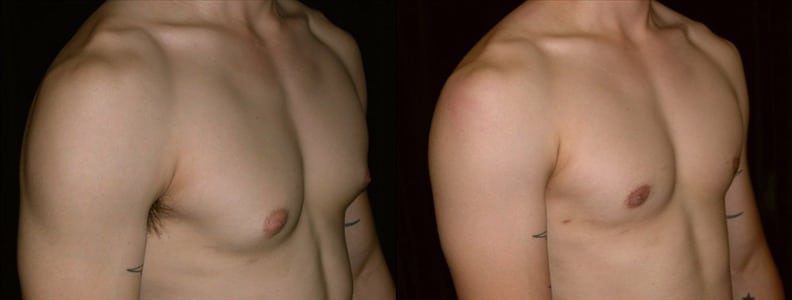 Gynecomastia Patient 8 Before & After