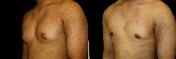 Gynecomastia Patient 11 Before & After Details