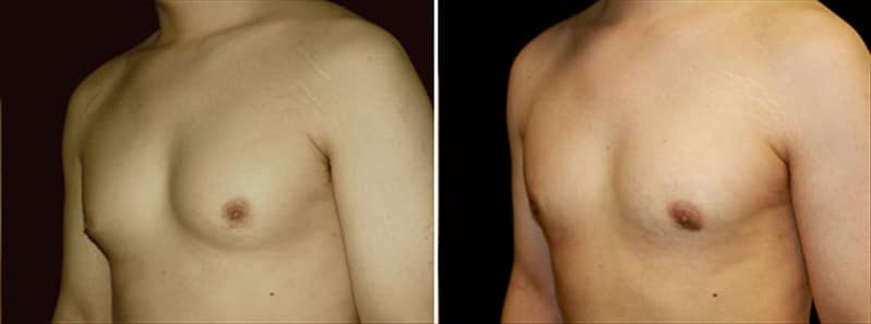 Gynecomastia Patient 7 Before & After Details