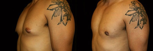 Gynecomastia Patient 1 Before & After Details