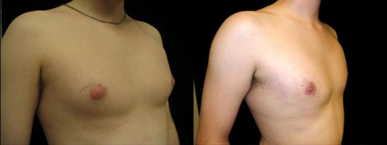 Gynecomastia Patient 1 Before & After Details