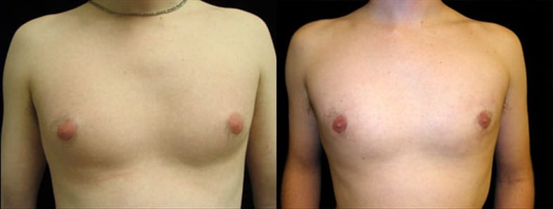 Gynecomastia Patient 1 Before & After