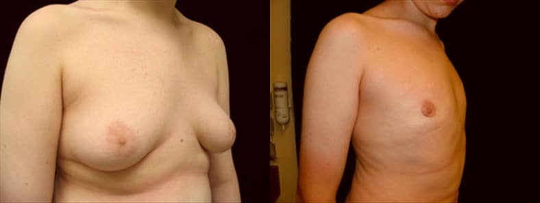 Gynecomastia Patient 16 Before & After Details
