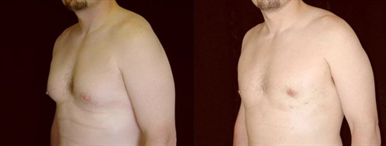 Gynecomastia Patient 12 Before & After