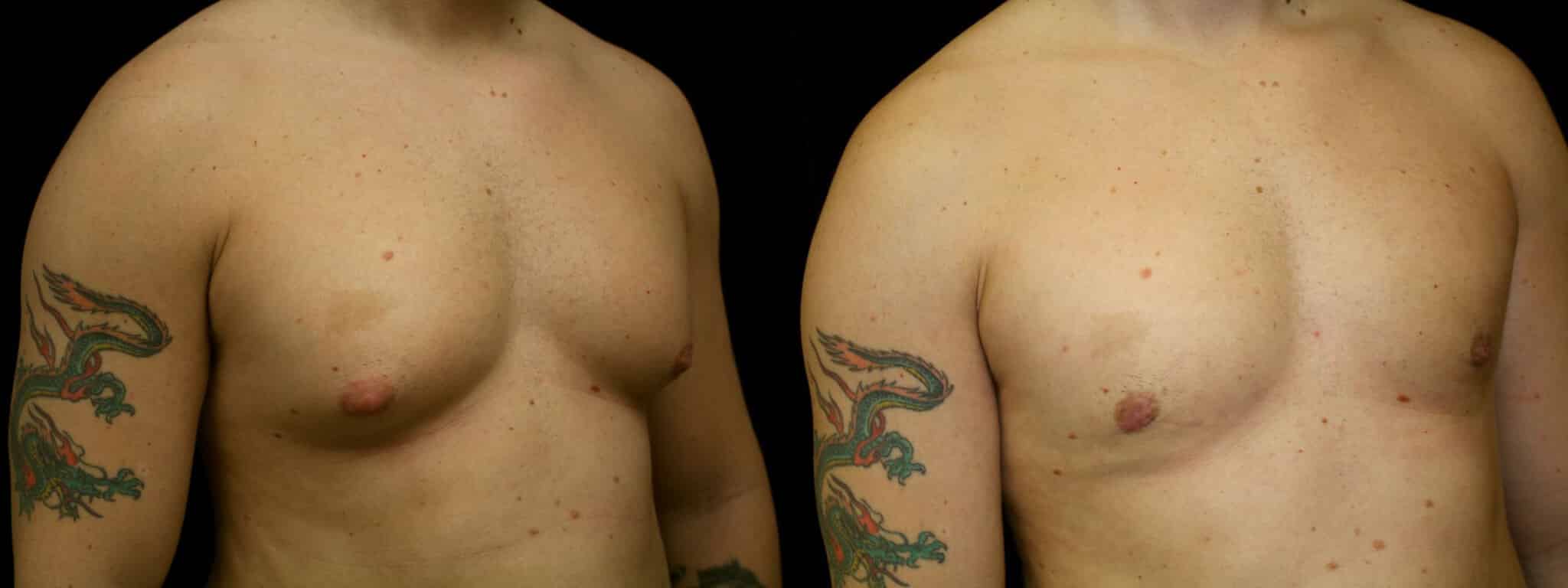 Gynecomastia Patient 5 Before & After Details