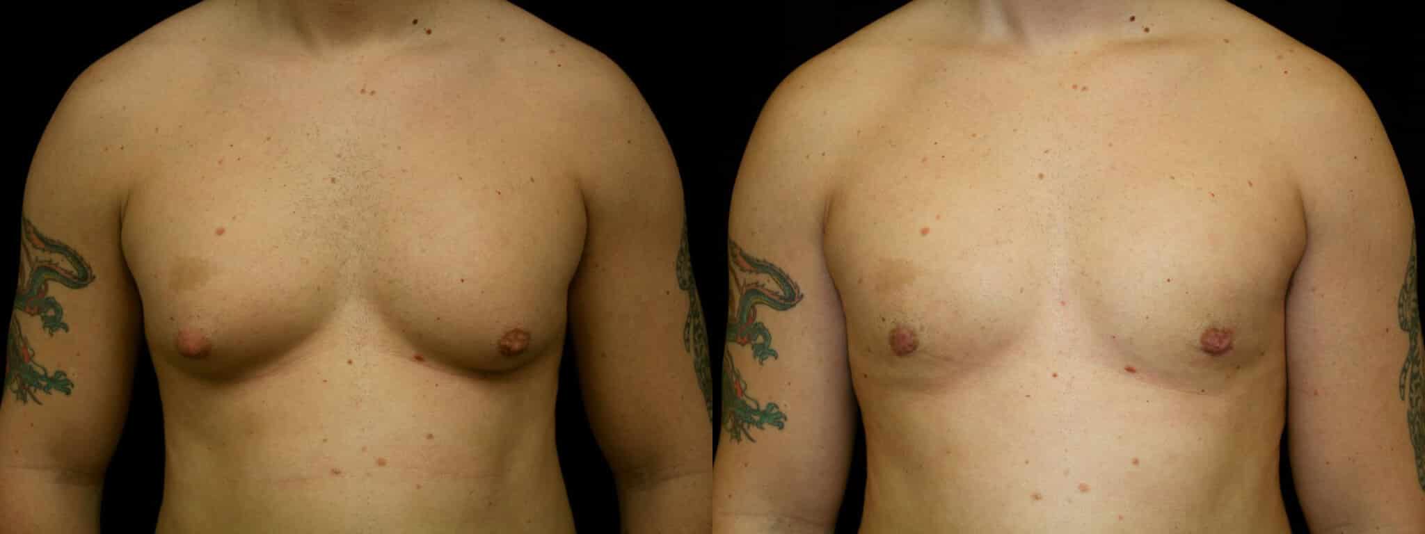 Gynecomastia Patient 5 Before & After