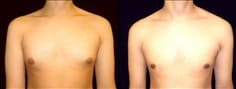 Gynecomastia Patient 18 Before & After