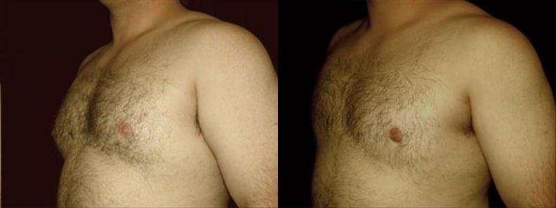 Gynecomastia Patient 10 Before & After Details