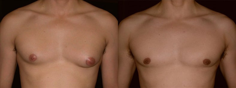 Gynecomastia Patient 4 Before & After