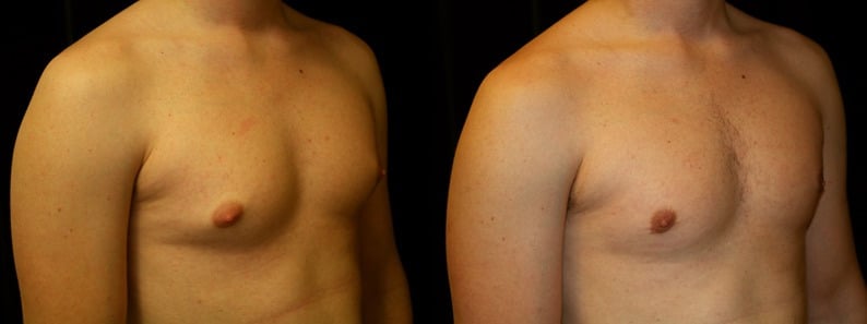 Gynecomastia Patient 4 Before & After Details