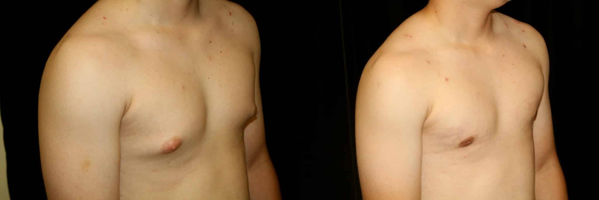 Gynecomastia Patient 20 Before & After Details