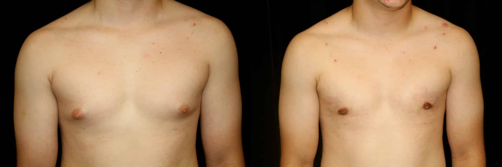 Gynecomastia Patient 20 Before & After