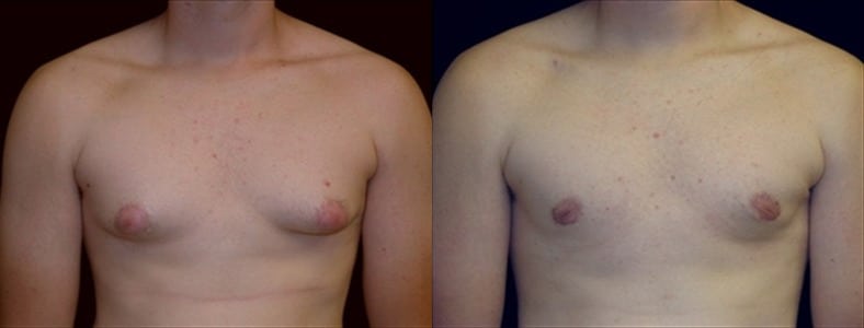 Gynecomastia Patient 4 Before & After