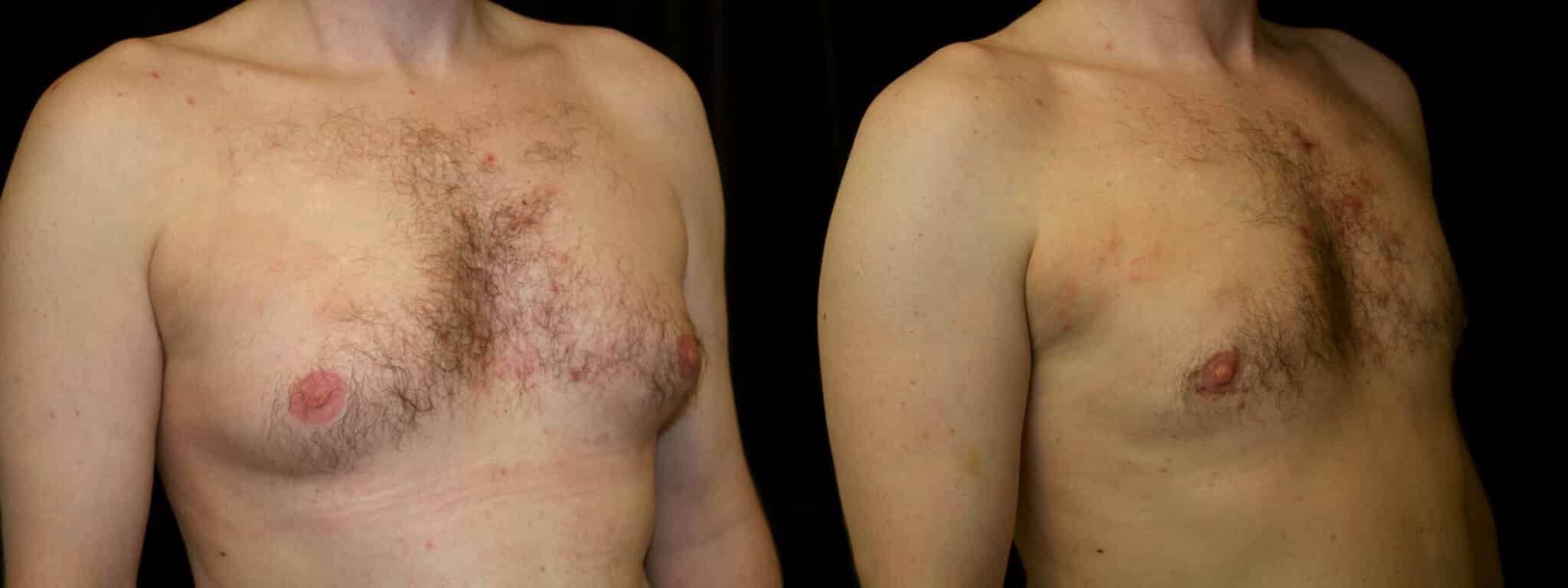 Gynecomastia Patient 4 Before & After Details