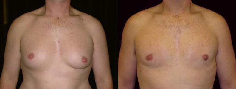 Gynecomastia Patient 7 Before & After