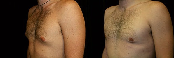 Gynecomastia Patient 13 Before & After Details