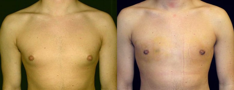 Gynecomastia Patient 21 Before & After